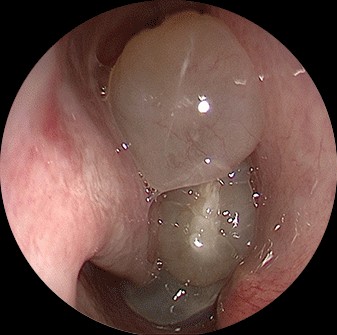 Endoscopia nasal mostrando pólipo de superfície lisa e translúcida emergindo do meato médio